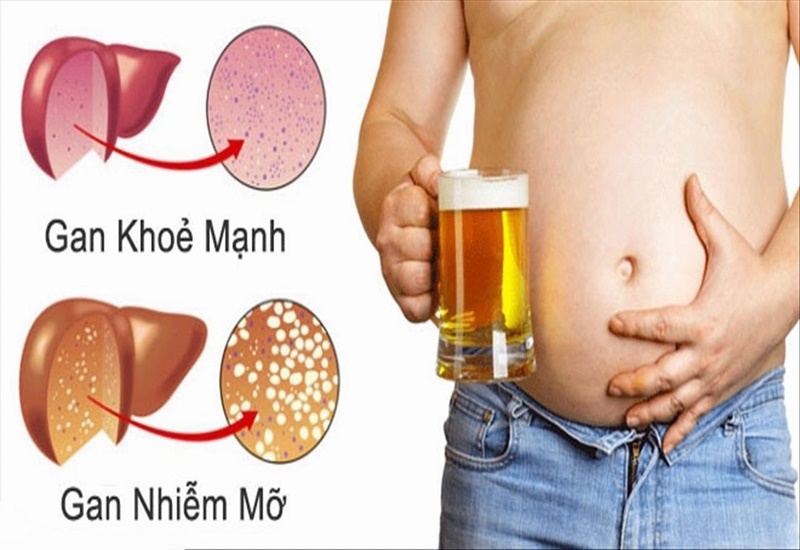 Giải pháp tự nhiên cho gan nhiễm mỡ và men gan cao là gì ?